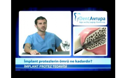 implant-protezlerin-omru-ne-kadardir