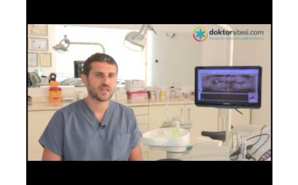 diş implantı ne demektir,diş implantı tedavisi,diş ekimi nedir,diş implantı süresi,diş implant operasyonu,metal diş kökü,yapay diş kökü,vidalı diş,yüksek tansiyon hastalarına implant uygulaması,implant tansiyon hastalarına uygalanabil